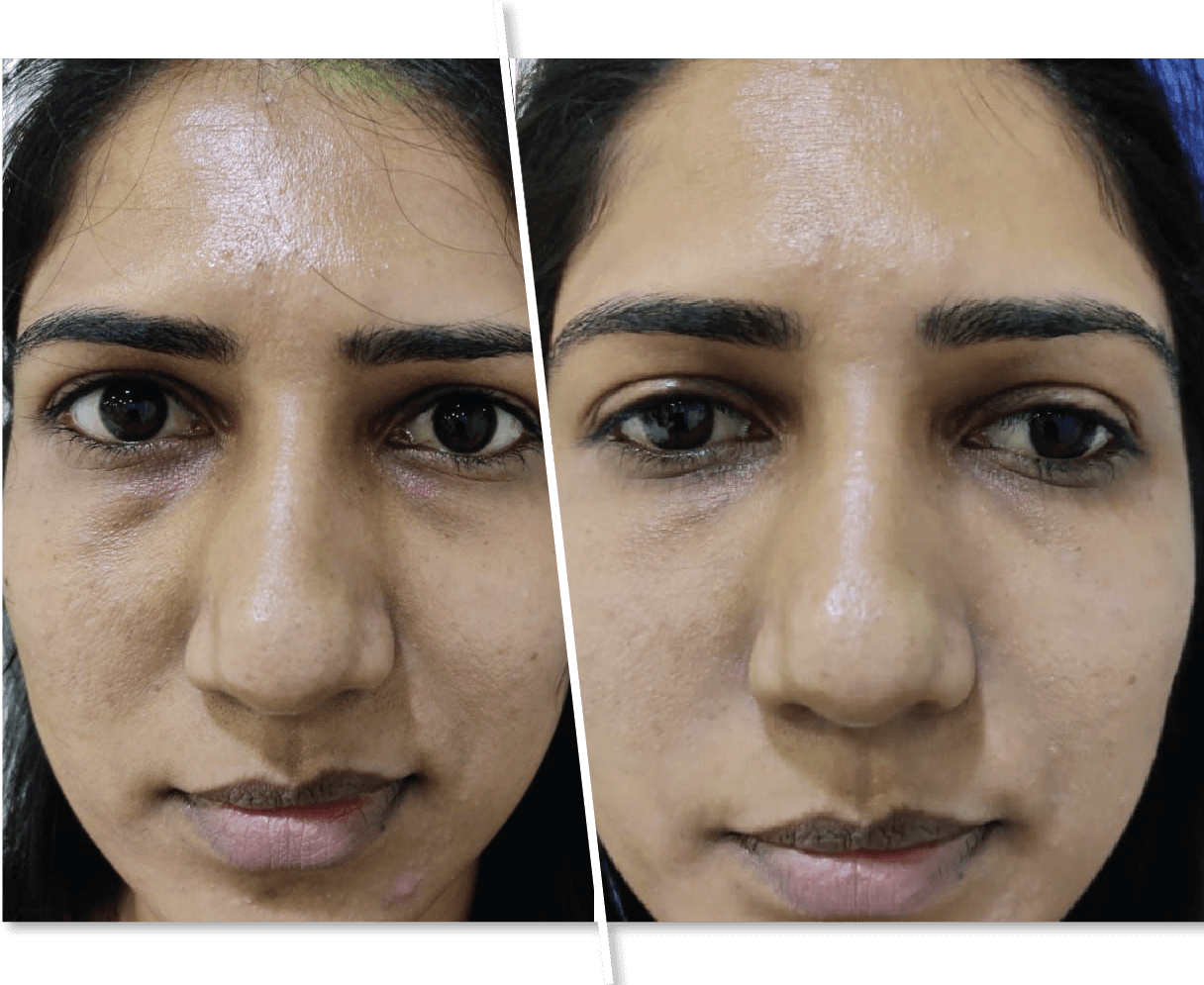 Dark Eye Circles Before and After Women